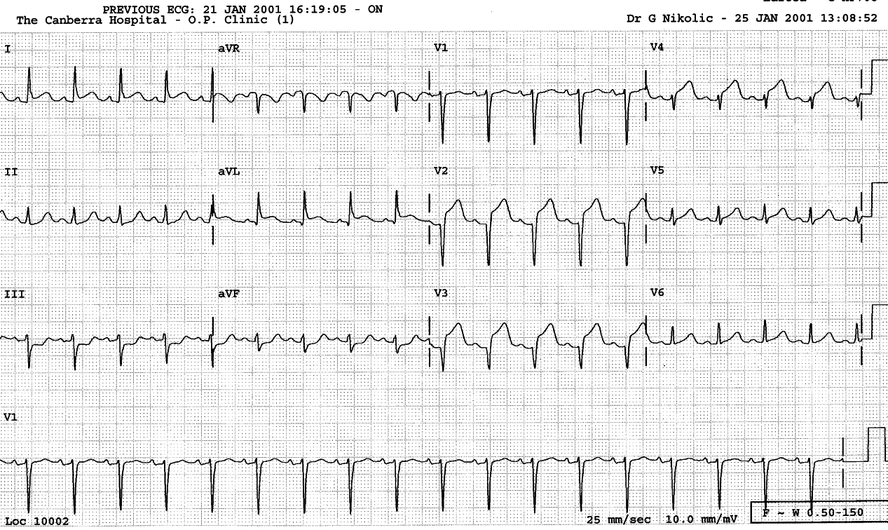 Normal conduction on admission. The anterior infarction looks acute or very recent.