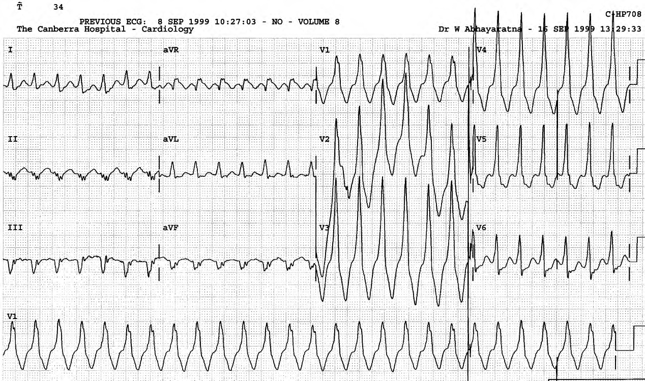 67 year old man with acute myeloid leukÃ¦mia during his first cycle of remission-induction chemotherapy with idarubicin and cytarabine. He has a history of bicuspid aortic valve, hypertension and LVH, with normal left ventricular systolic function (ejection fraction 77%). He now developed febrile neutropenia and hypokalÃ¦mia (3.4 mEq/L). 