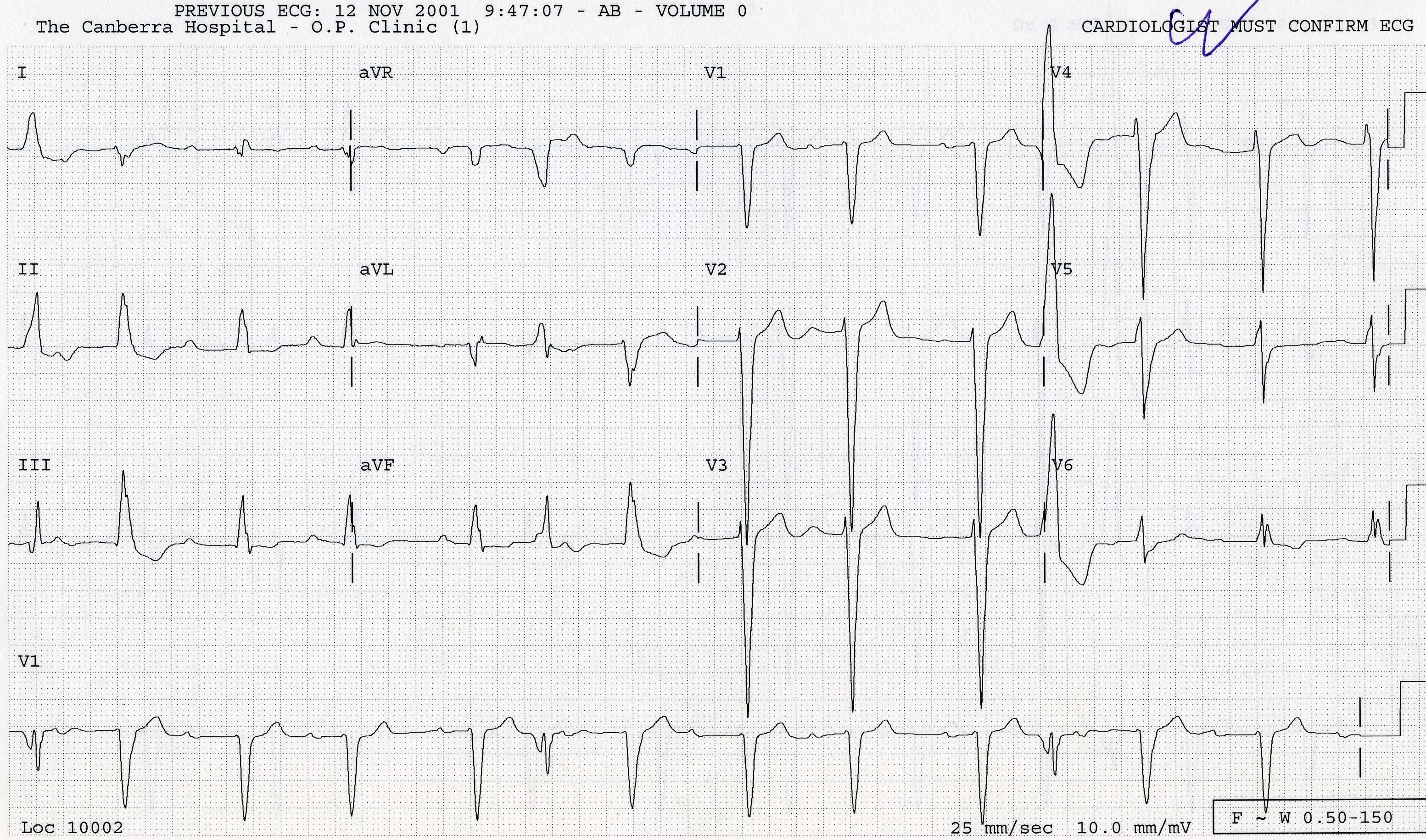 71 year old man with congestive cardiomyopathy (LV 7.2 cms) and 90% left circumflex artery stenosis. His ECG contains three FLBs with unusual consequences.