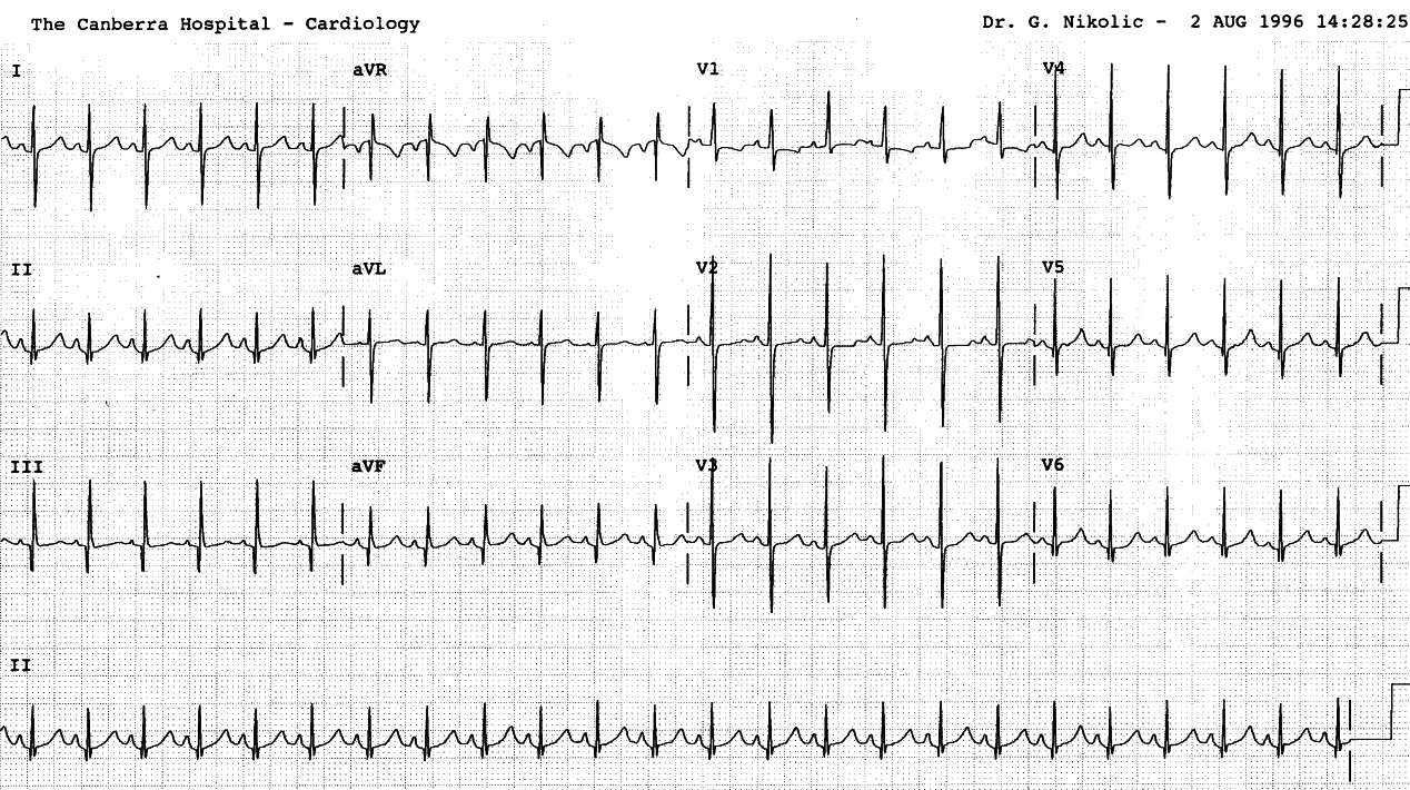 Healthy 5 weeks old evaluated for a systolic murmur