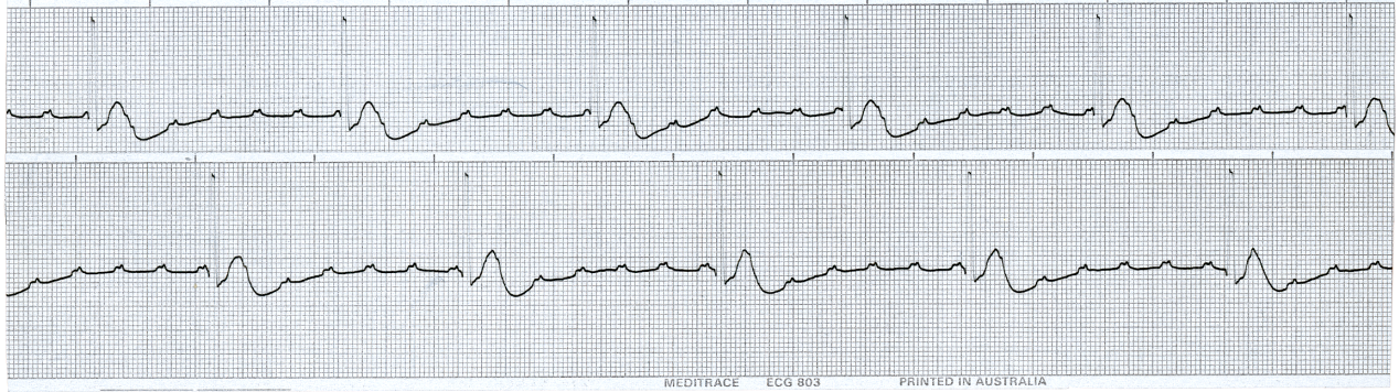 21 year old drug addict during his unsuccessful resuscitation in Casualty. No pulses were palpable during the recording shown