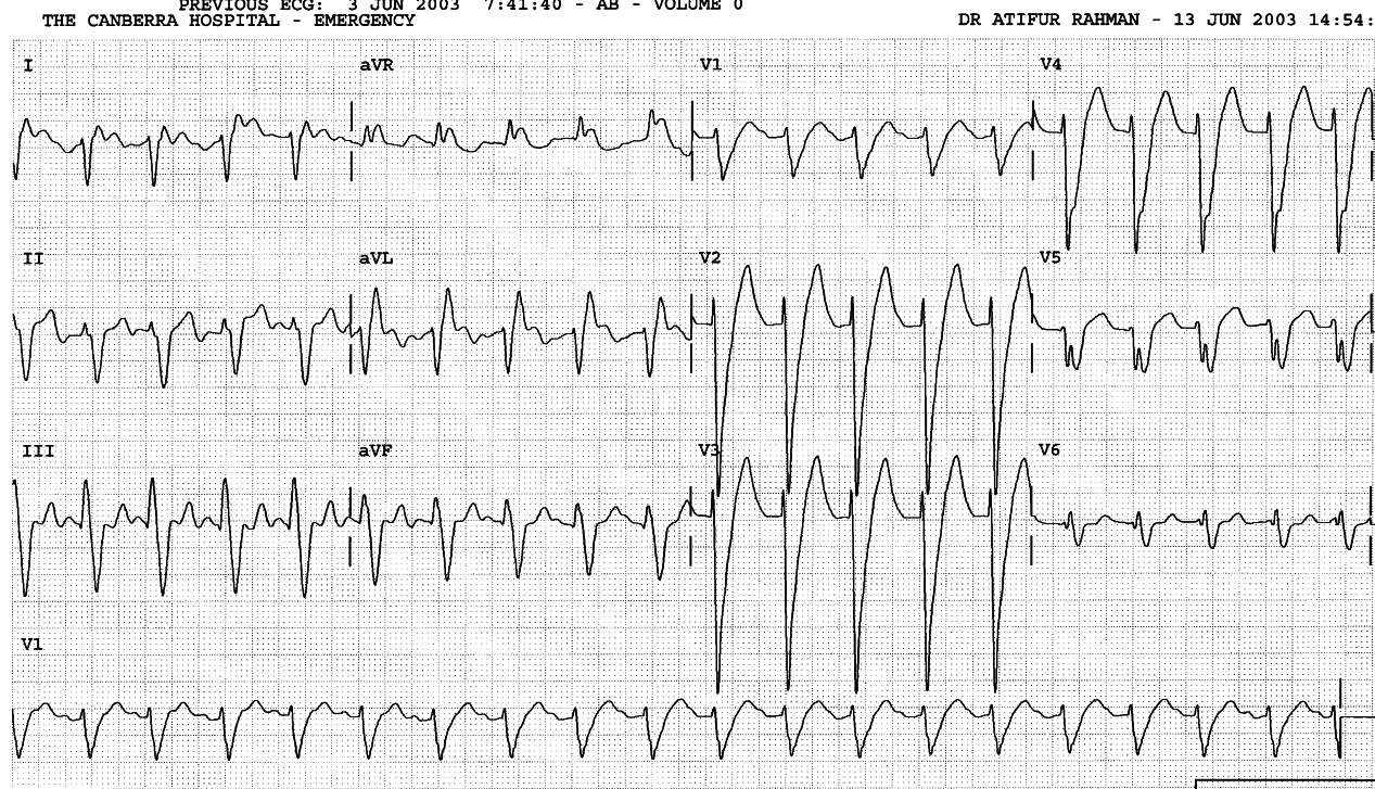 Uncertain P waves in tachycardia.