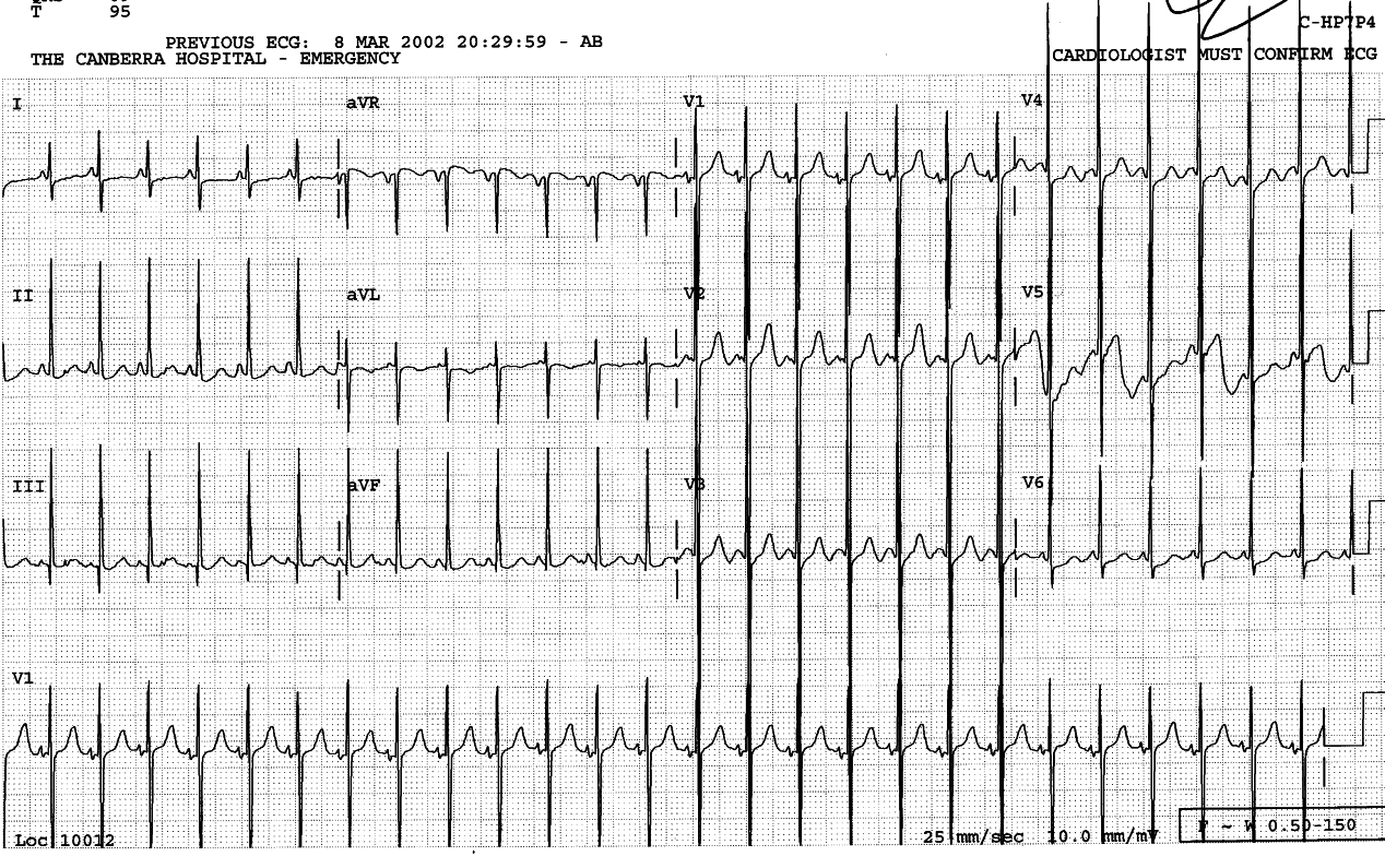 Two months old girl with large VSD about to be repaired