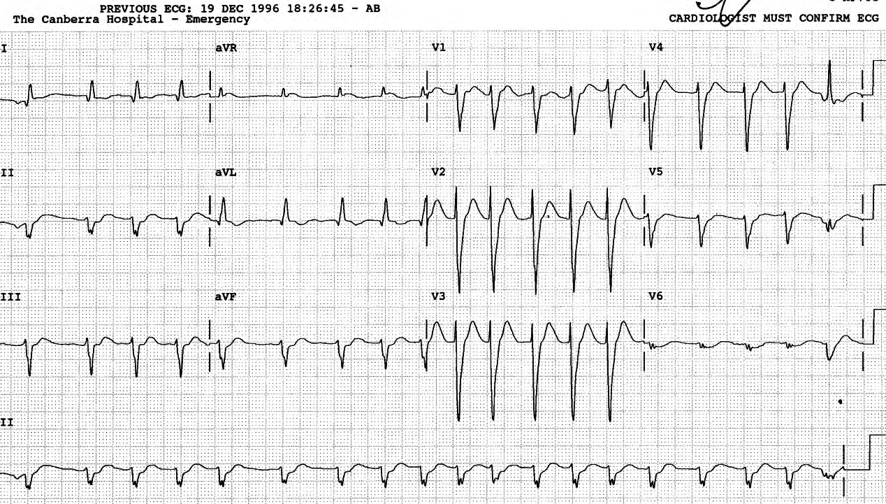 Prominent thin R waves in right precordial leads (V2 here) may be seen in anterior infarction and cardiomyopathy. 