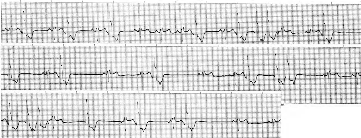 81 year old man with dizzy spells for the past fortnight. Some broad complexes are closely followed by normal ones; why? Also, what is happening to the sinus node? 