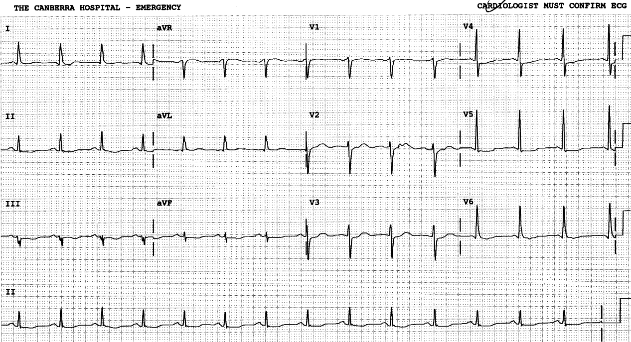 More atropine! 