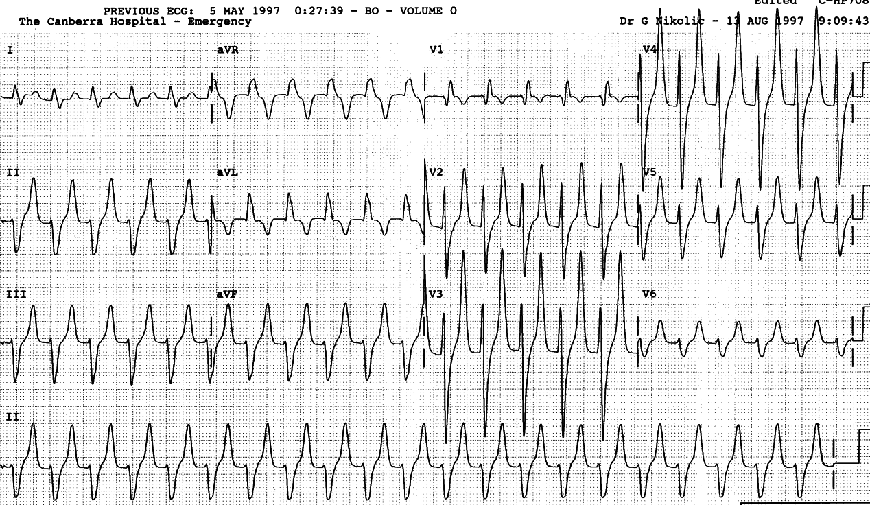 26 year old man on chronic hÃ¦modialysis, in Casualty with symptomatic urÃ¦mia