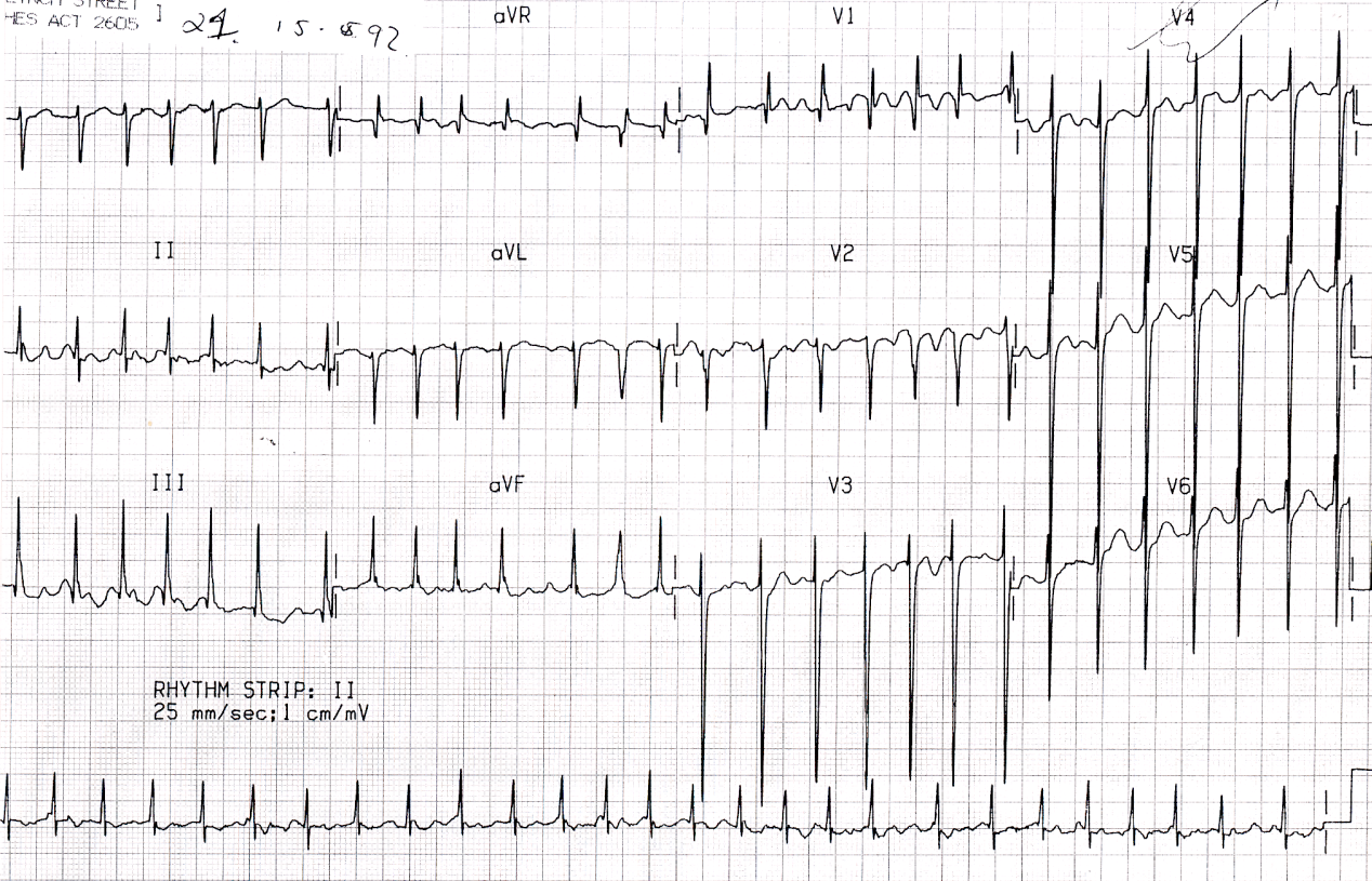 76 year old woman with advanced cor pulmonale