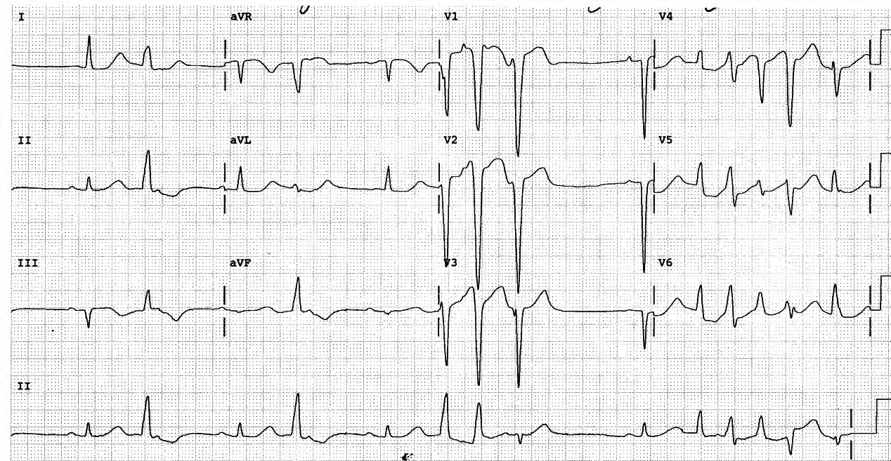 77 year old lady on sotalol for atrial tachyarrhythmias. 