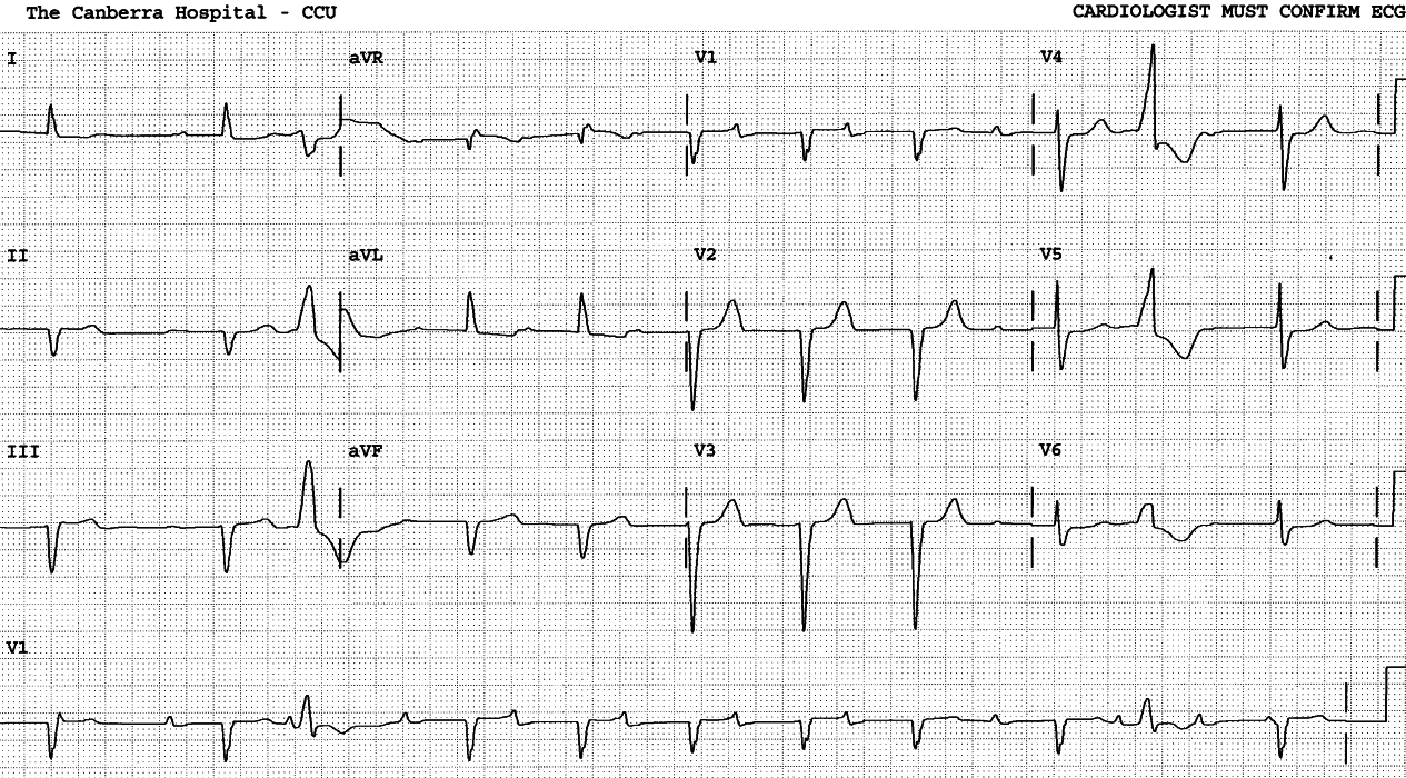 78 year old man past history of myocardial     infarctions. 