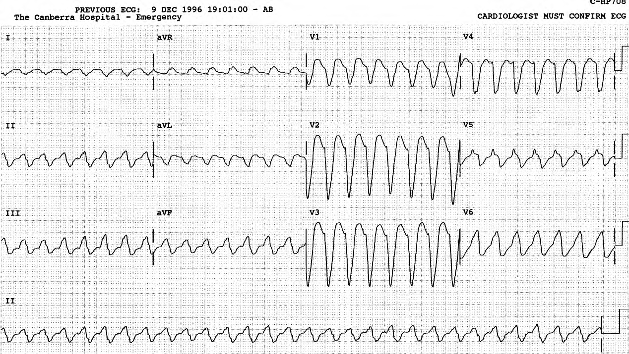 68 year old lady who had atrial tachycardia 175-180/min with 2:1 block. She received three quinidine bisulphate tablets at midnight and another two, with 0.5 mg digoxin, two hours later. Fifteen minutes after that the tachycardia shown below developed, reverting spontaneously several times over the next four hours. There was no response to xylocaine. 