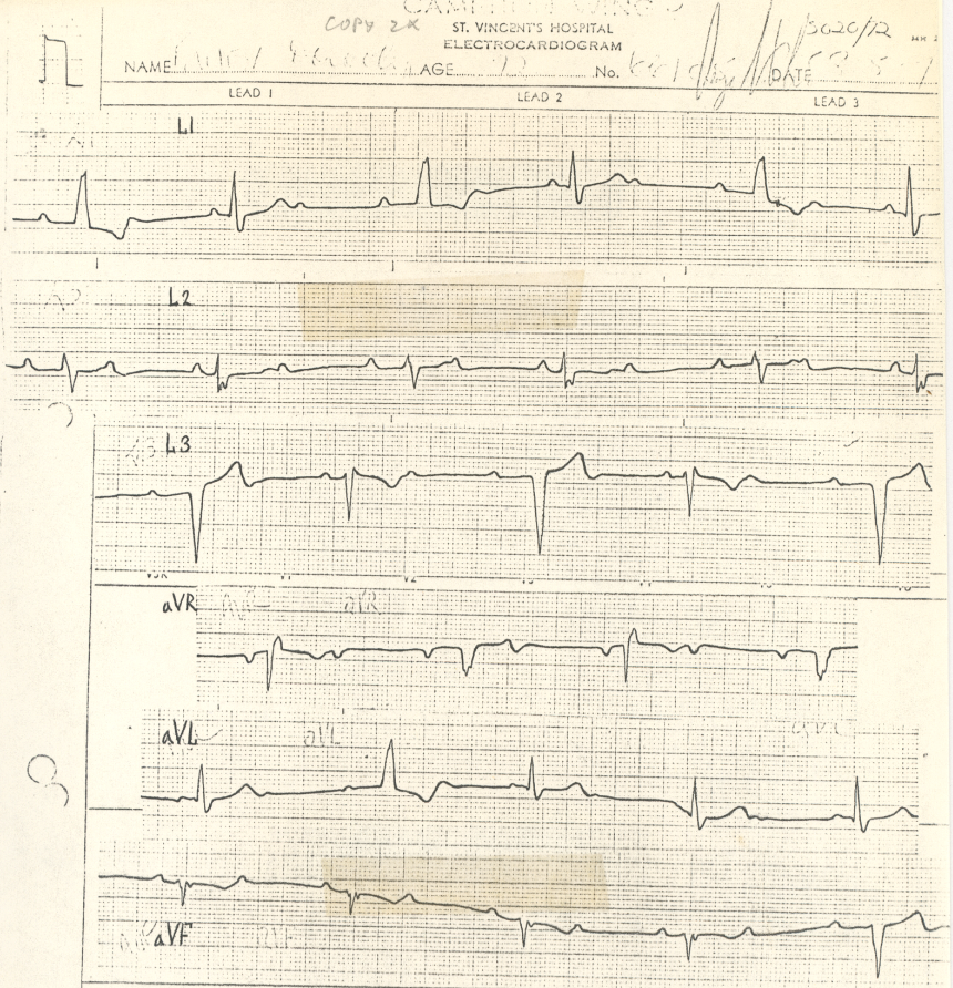 71 year old lady awaiting a pacemaker in 1972.