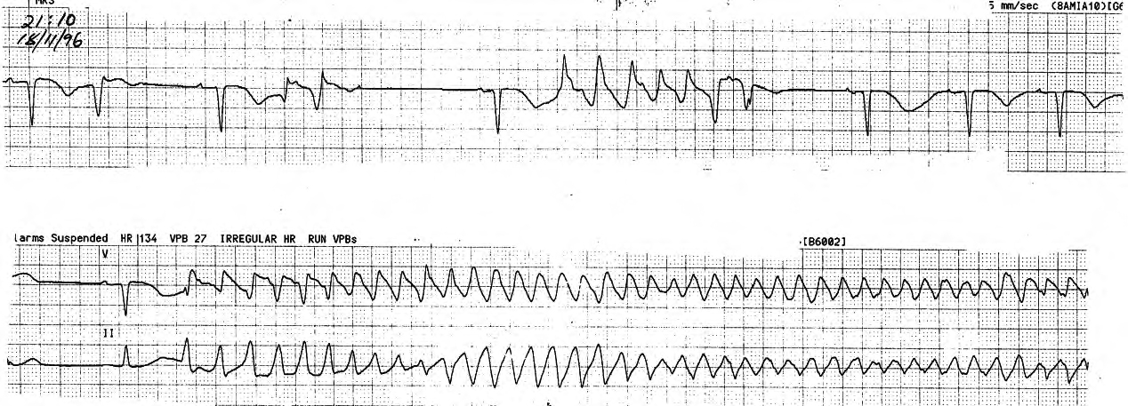 Torsades de pointes. The QT interval increases with the cycle length, creating a vicious circle. 