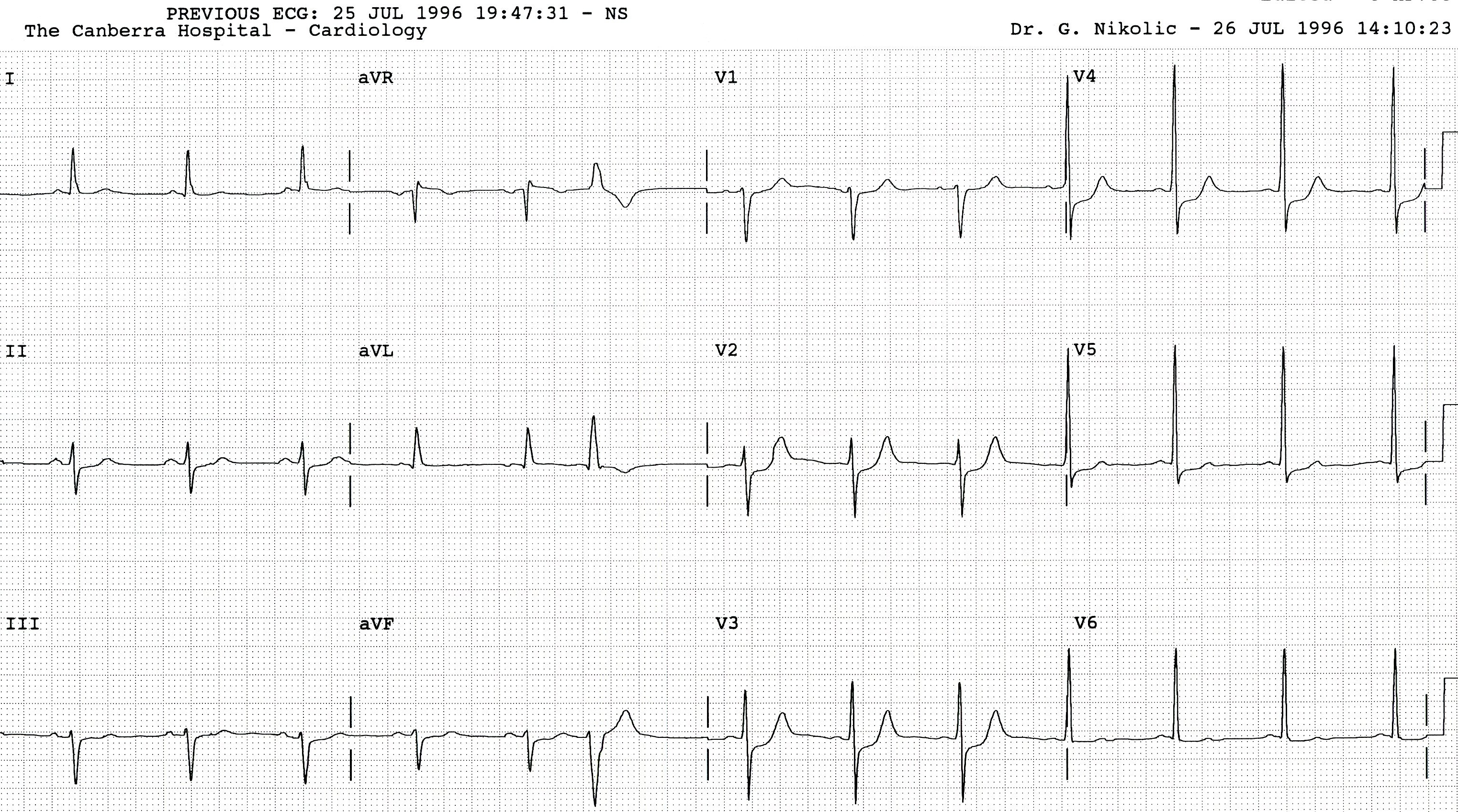 Admission ECG, basically the same as in Fig 406b.