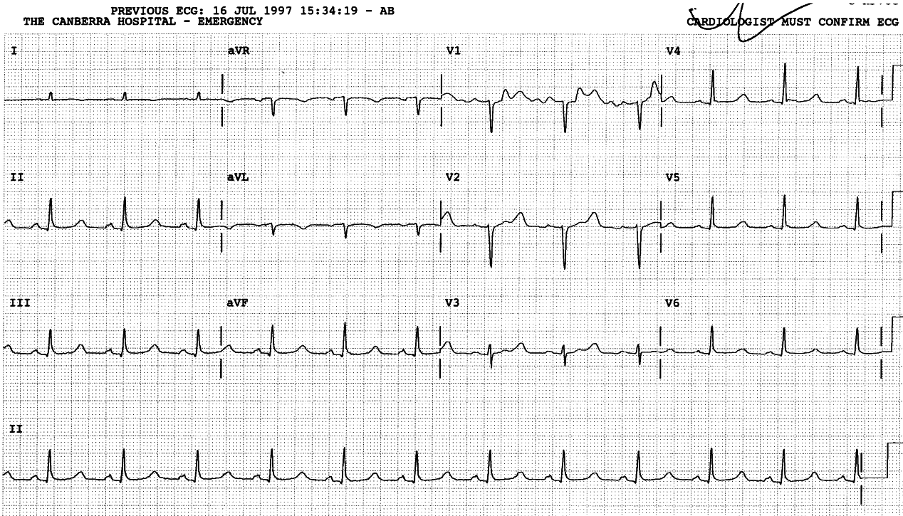 55 year old diabetic with chronic renal failure