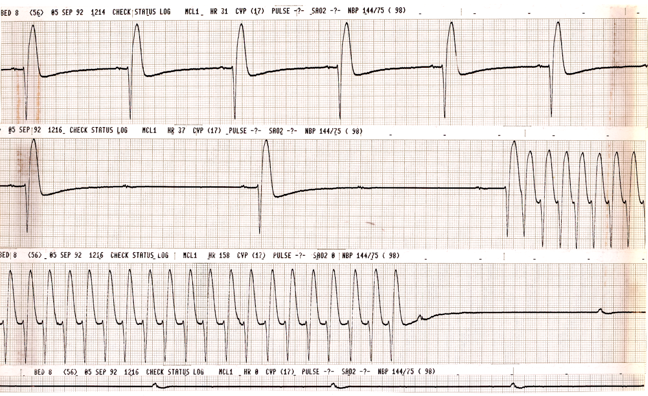 Brain-dead 70 year old lady 24 hours after (obviously complicated) carotid endarterectomy