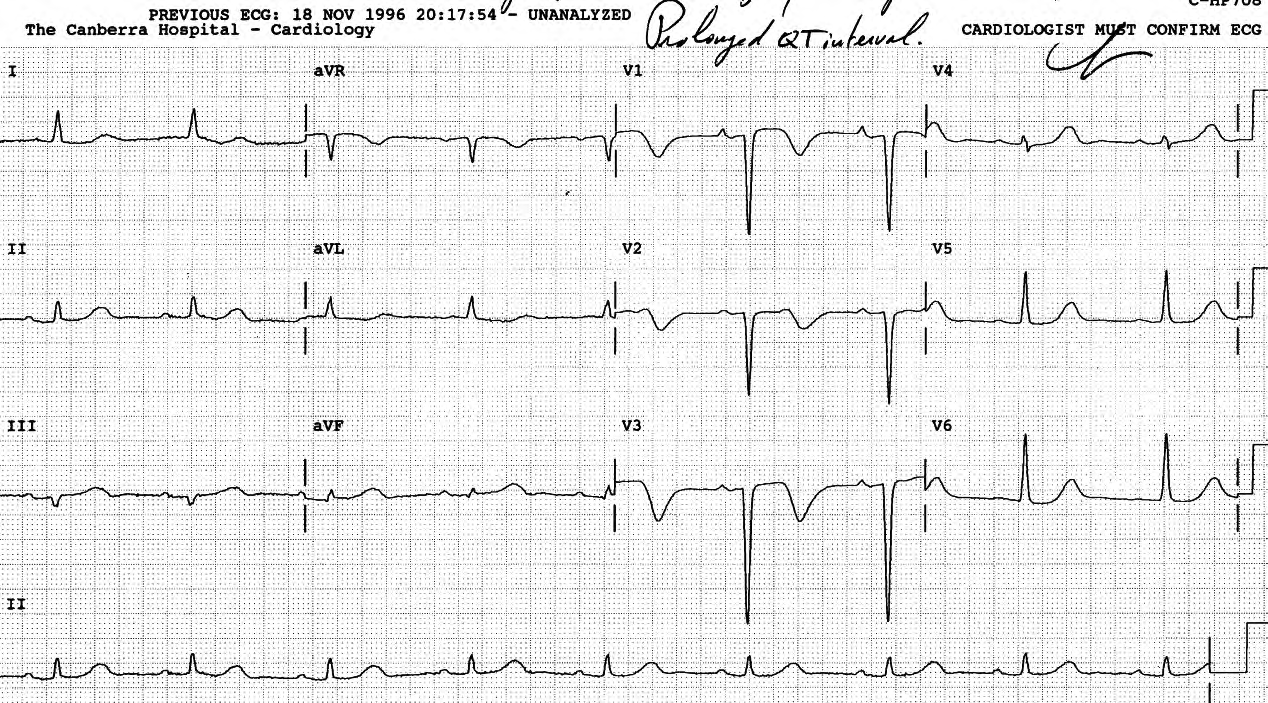 The anteroseptal T wave inversion may be due to preceding VT or syncope. 