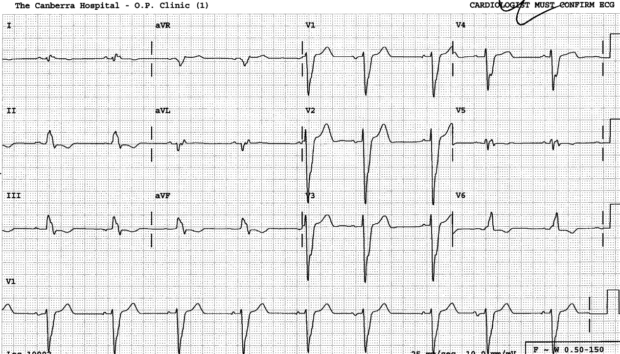 Tall thin R wave in V2-3 may be a sign of anterior infarction in LBBB conduction (see Case 23).