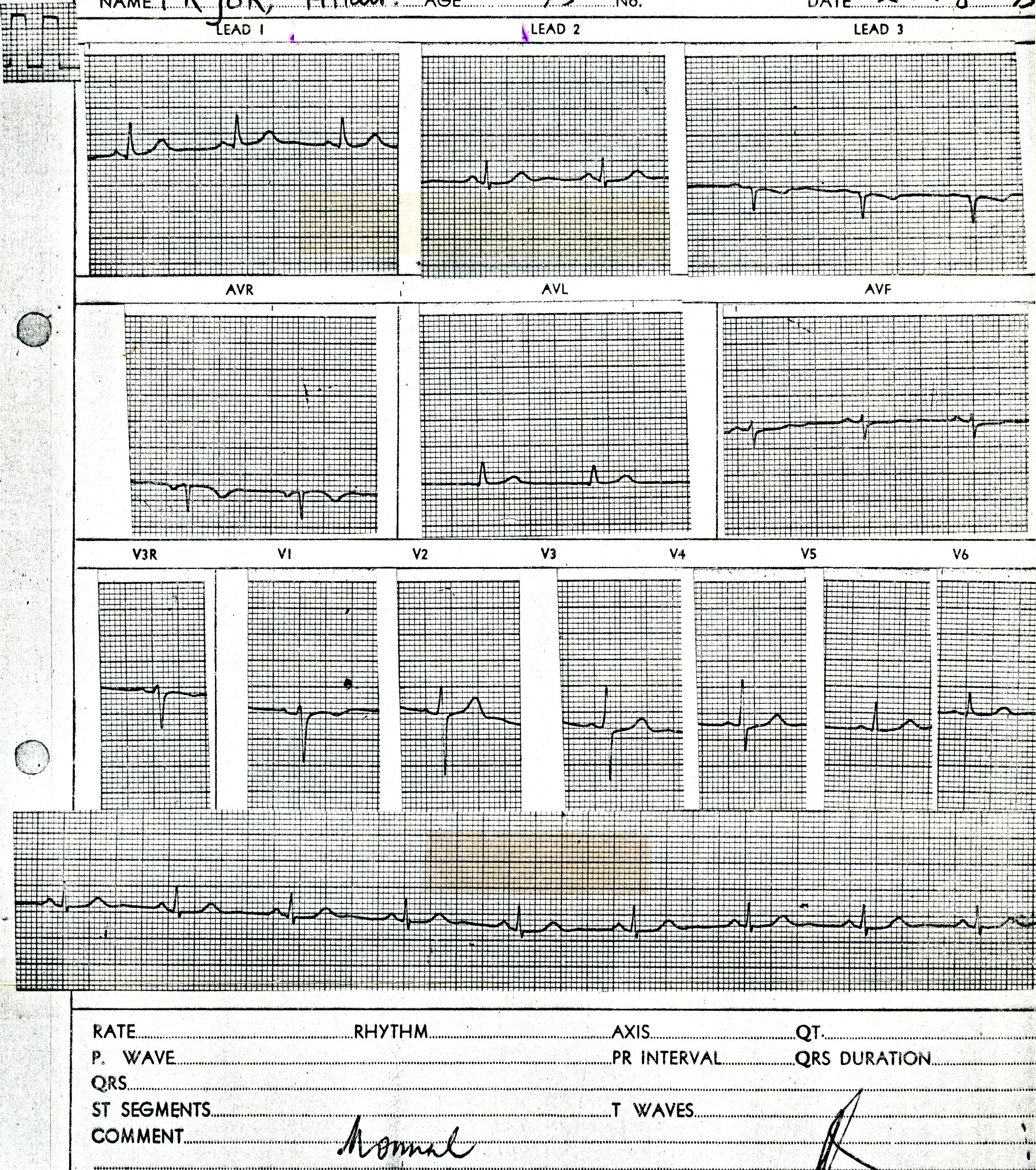 45 year old man with severe angina pectoris.