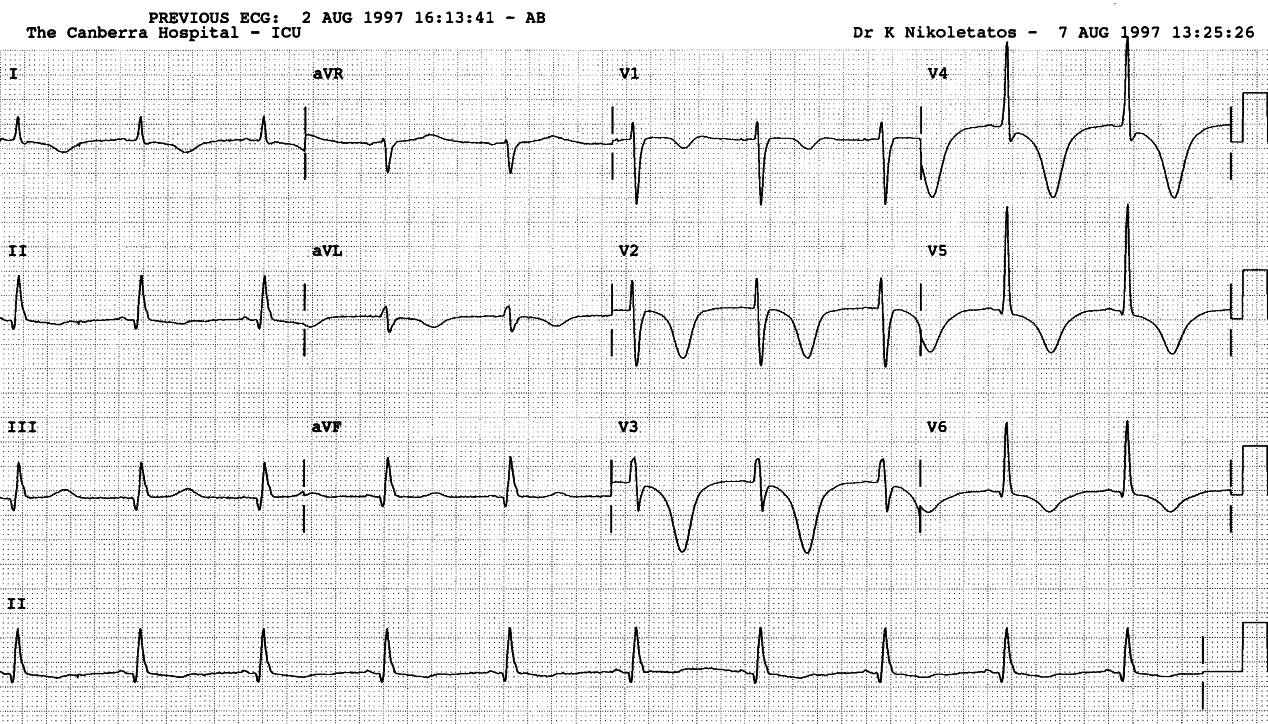 73 year old man ventilated after laparotomy for ruptured diverticular abscess. He has a history of remote infarction and subsequent CCF.