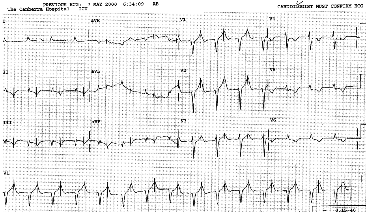 Routine ECG on a 64 year old man following CABGs.