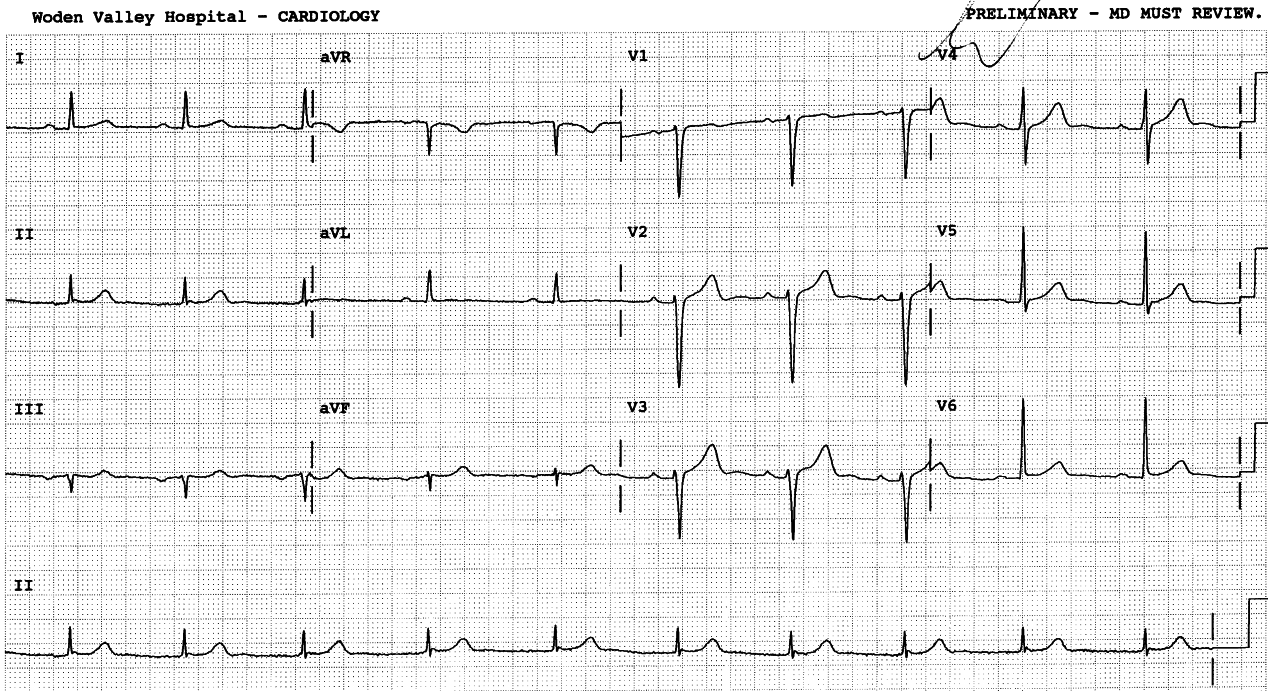 Routine ECG taken as part of a life-insurance examination. The rhythm strip caused referral to the Cardiology Clinic