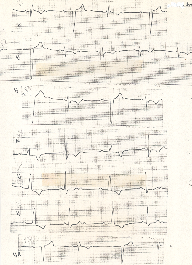 Chest leads from the same recording.