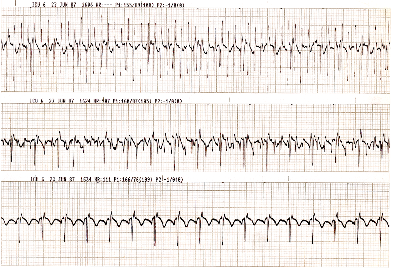 69 year old man with severe hypoxic encephalopathy following a postoperative respiratory arrest (on the ward). What is the treatment of choice for the phenomena illustrated below?