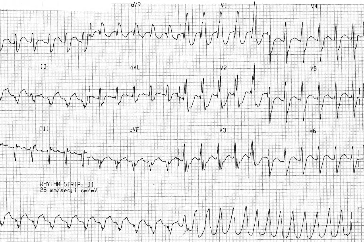 72 year old man with recurrent palpitations. 