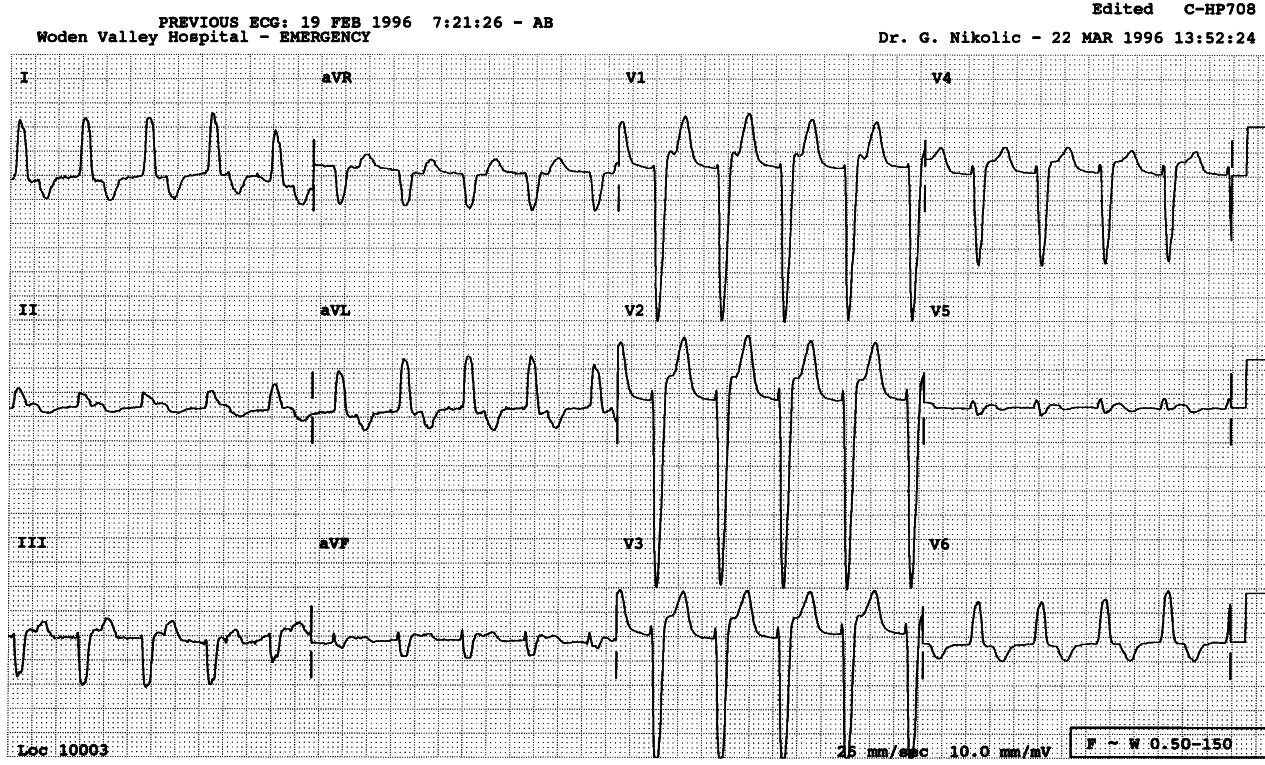 Digitalised 76 year old man with chronic LBBB.