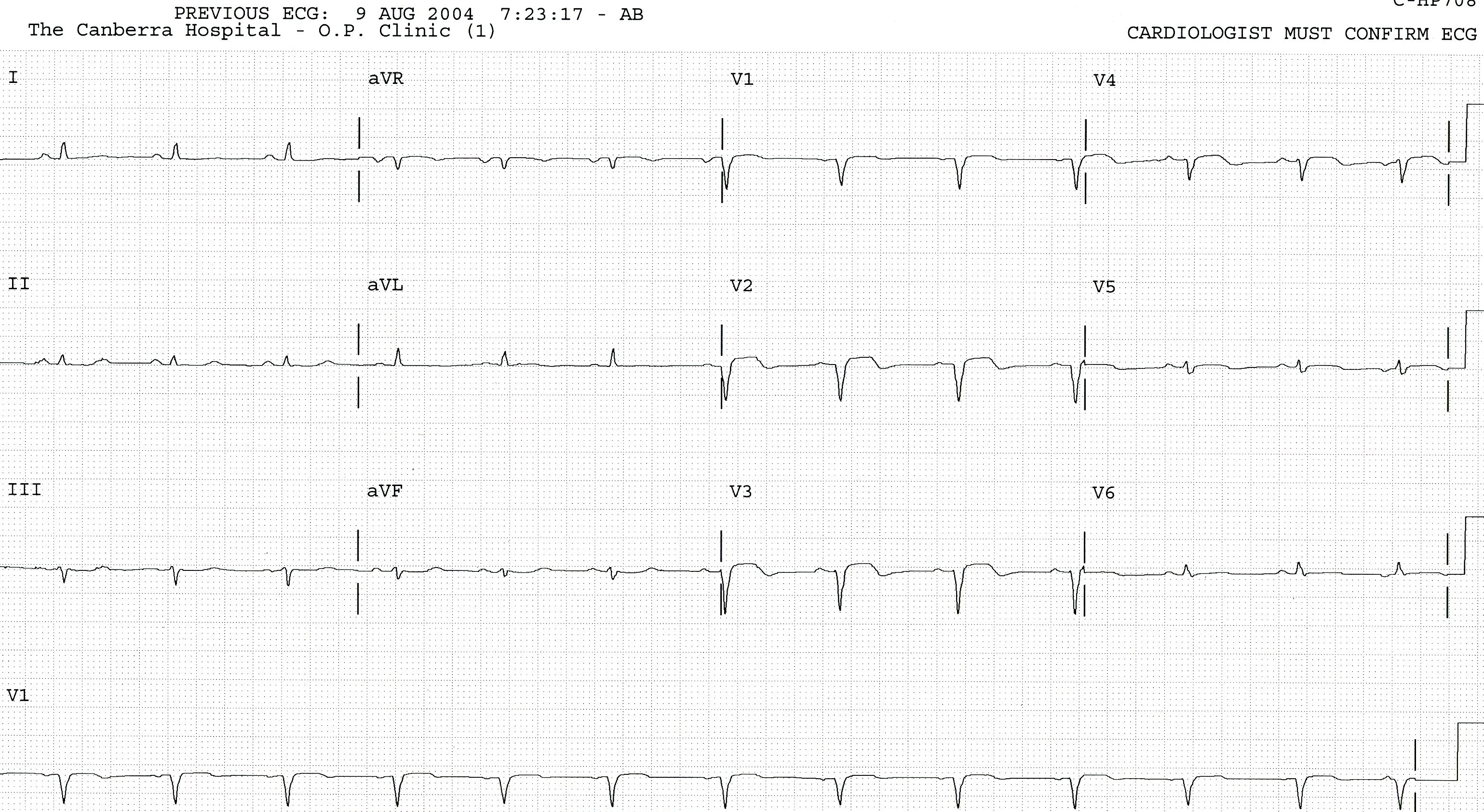 83 year old man on routine Outpatiens visit.