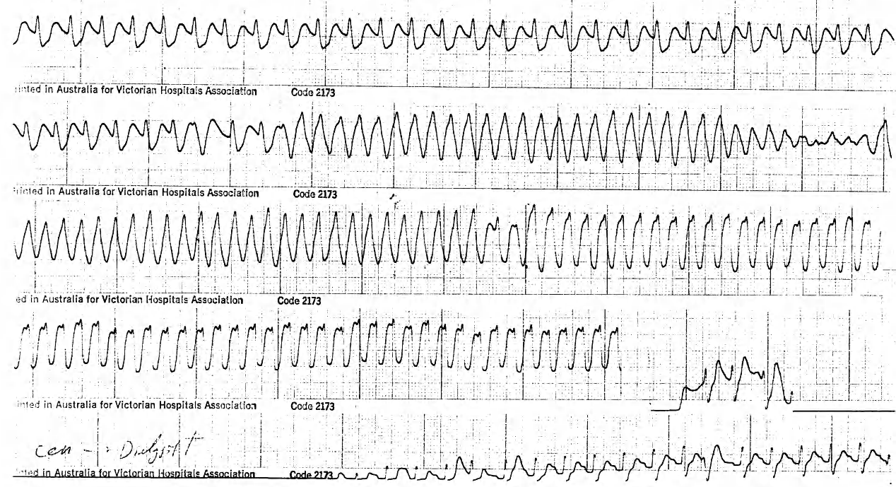 Post-gastrectomy acute renal failure in a 61 year old man with no previous heart disease. 