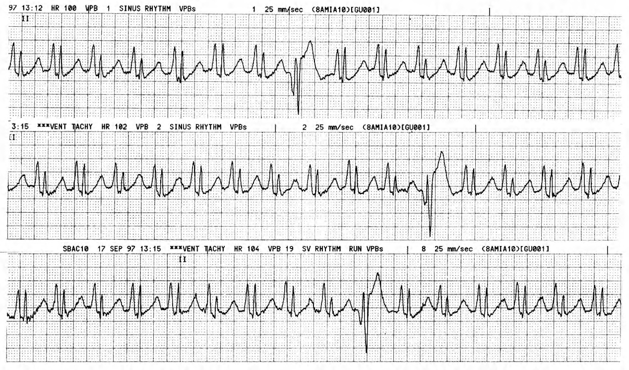 50 year old lady with dilated (6.3 cms) LV and fractional shortening 14% despite mitral incompetence. She had apical and septal hypokinesia. 