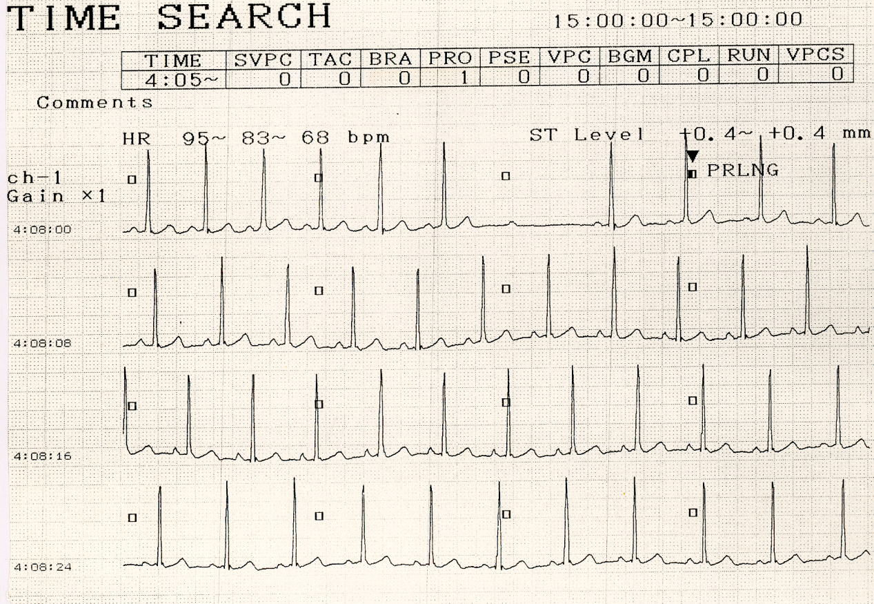 Healthy 20 year old having a Holter monitor for palpitations. 