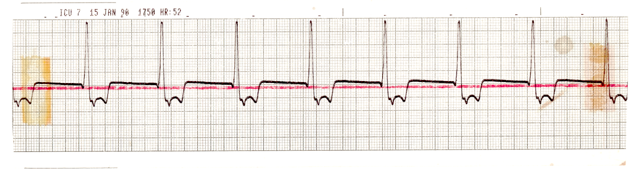 Agonal rhythm in a brain-dead 28 year old