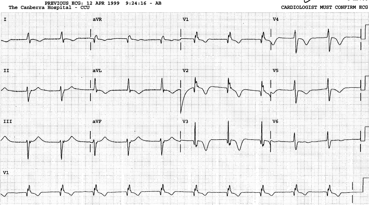 Preoperative ECG, in junctional rhythm with RBBB and LAHB
resolved, oddly enough, after CABGs.