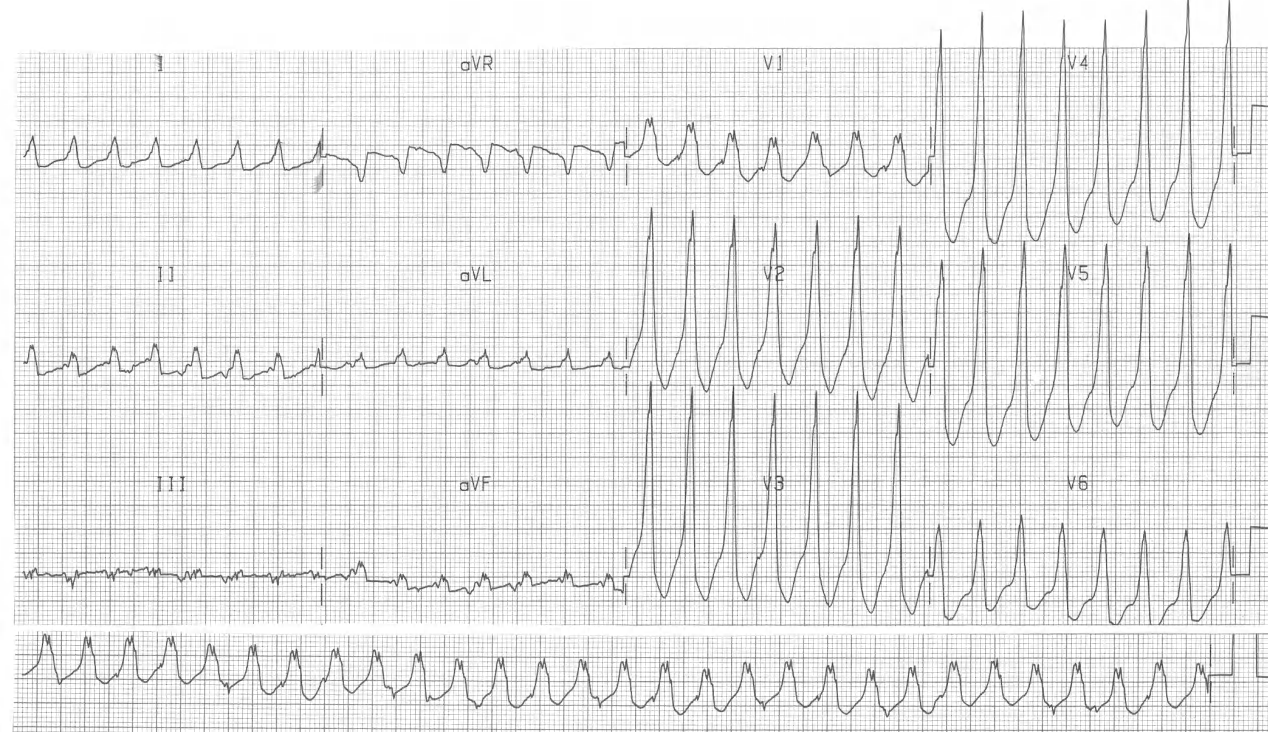 76 year old man with cardiomegaly and chronic LBBB, recovering in ICU from acute renal failure. 