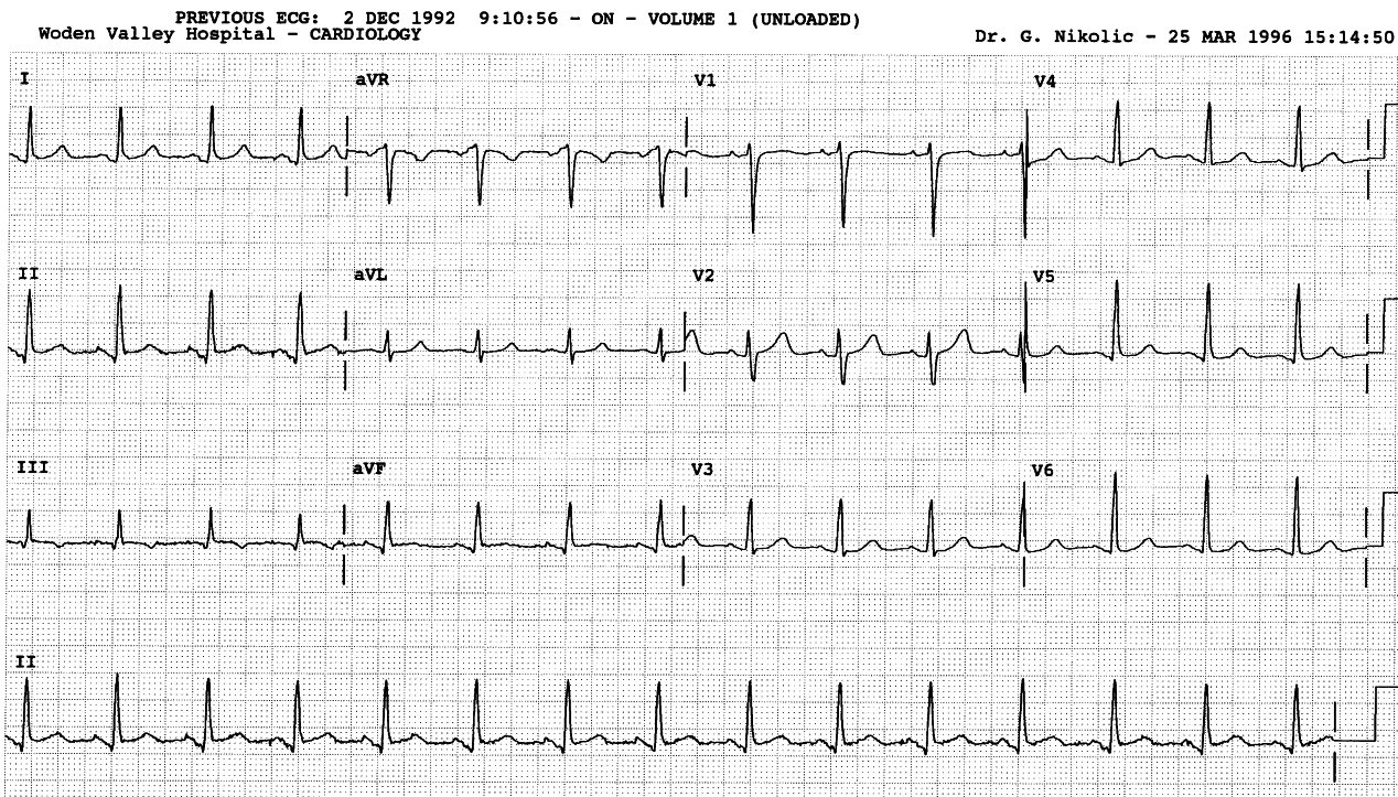 42 year old dialysis patient experiencing severe chest pain