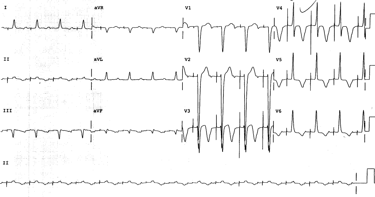 Two weeks post-implantation of a permanent pacemaker,
this patientâs ECG was neither here nor there.