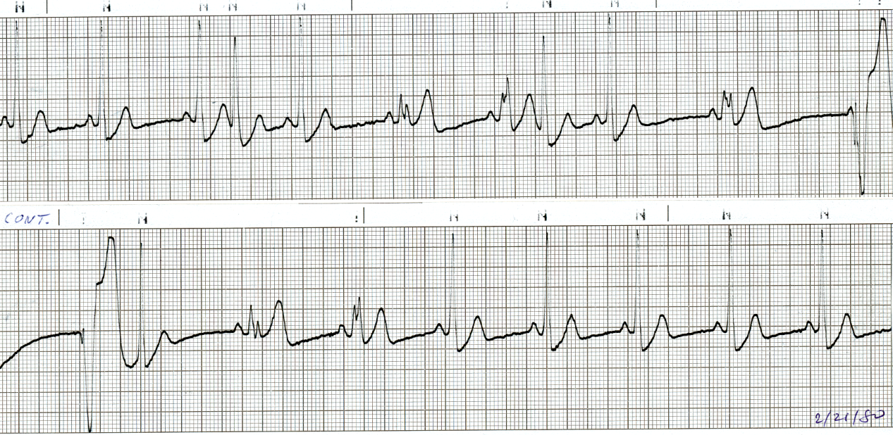 51 year old man with episodes of high-grade AV block requiring     pacing (same as Case 123), during carotid sinus massage. The result     surprised me. 