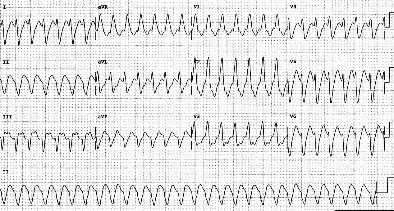 Casualty ECG of a confused 83 year old man with chronic LBBB and ischÃ¦mic cardiomyopathy. 