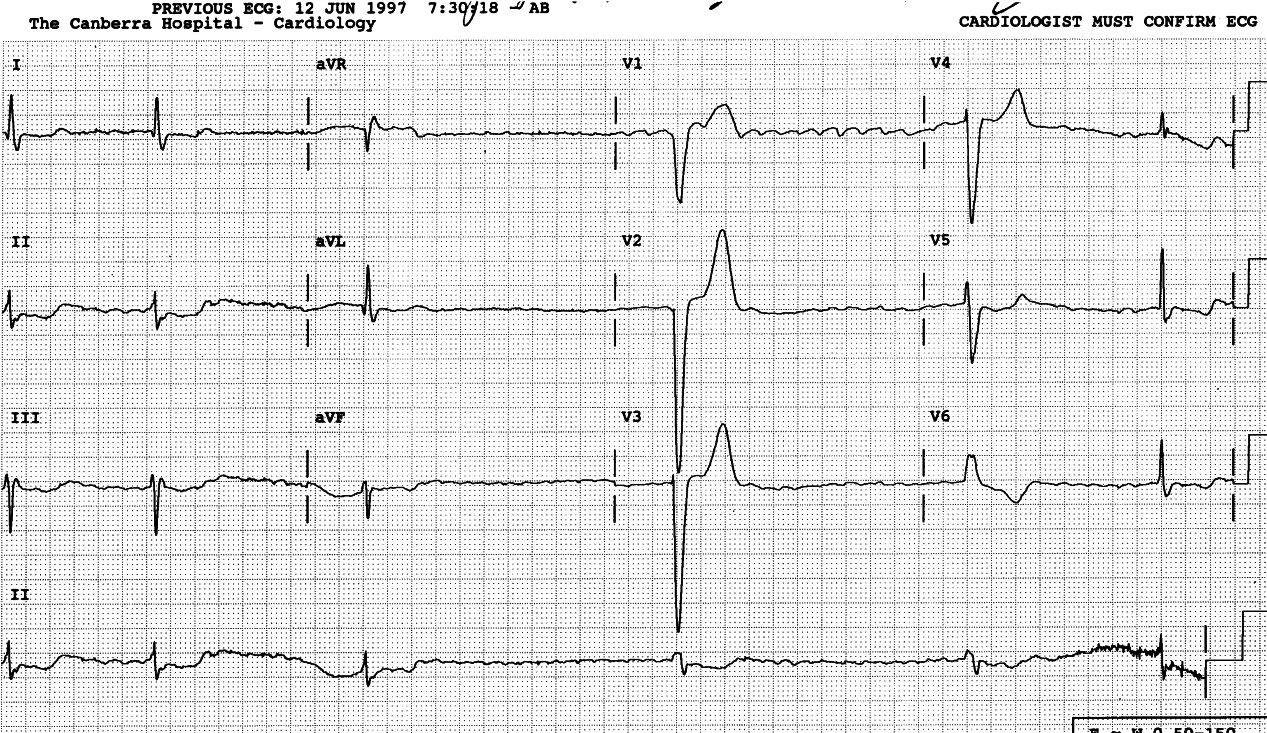 82 year old lady on digoxin therapy, transferred from her nursing home with progressive confusion and bradycardia.