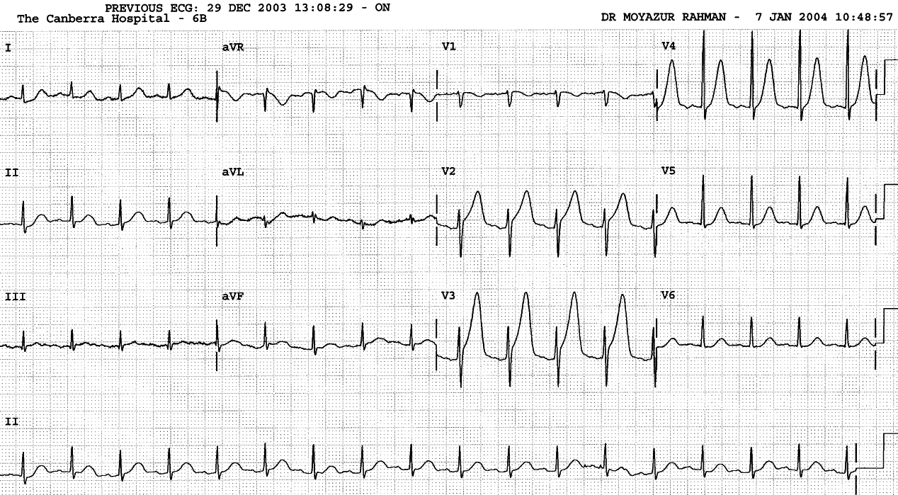 14 year old girl with Strep. viridans mitral endocarditis and sudden onset of central chest pain.