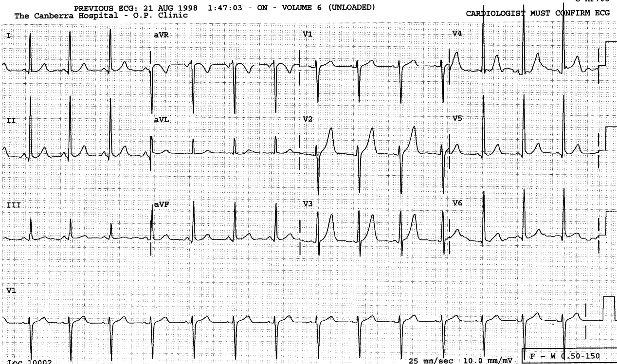 Asymptomatic 24 year old lady in Casualty following an episode of palpitations