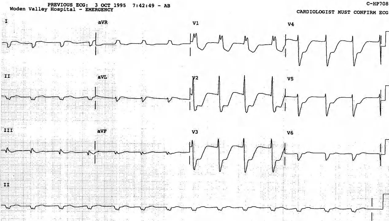 Terminal AIVR, with QRS similar to that of the bigeminal VT in Fig 87. 