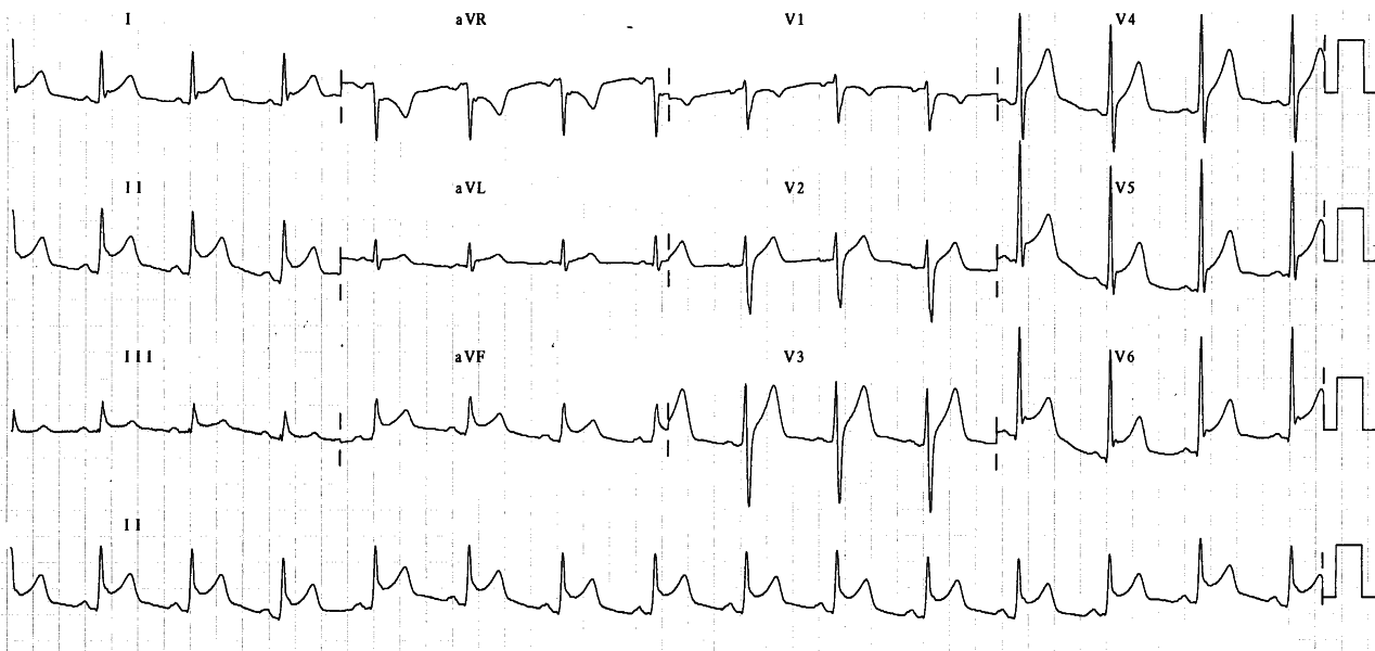 58 year old man with severe chest pain and history of PTCA to the LAD artery as well as pericarditis 10 years previously.