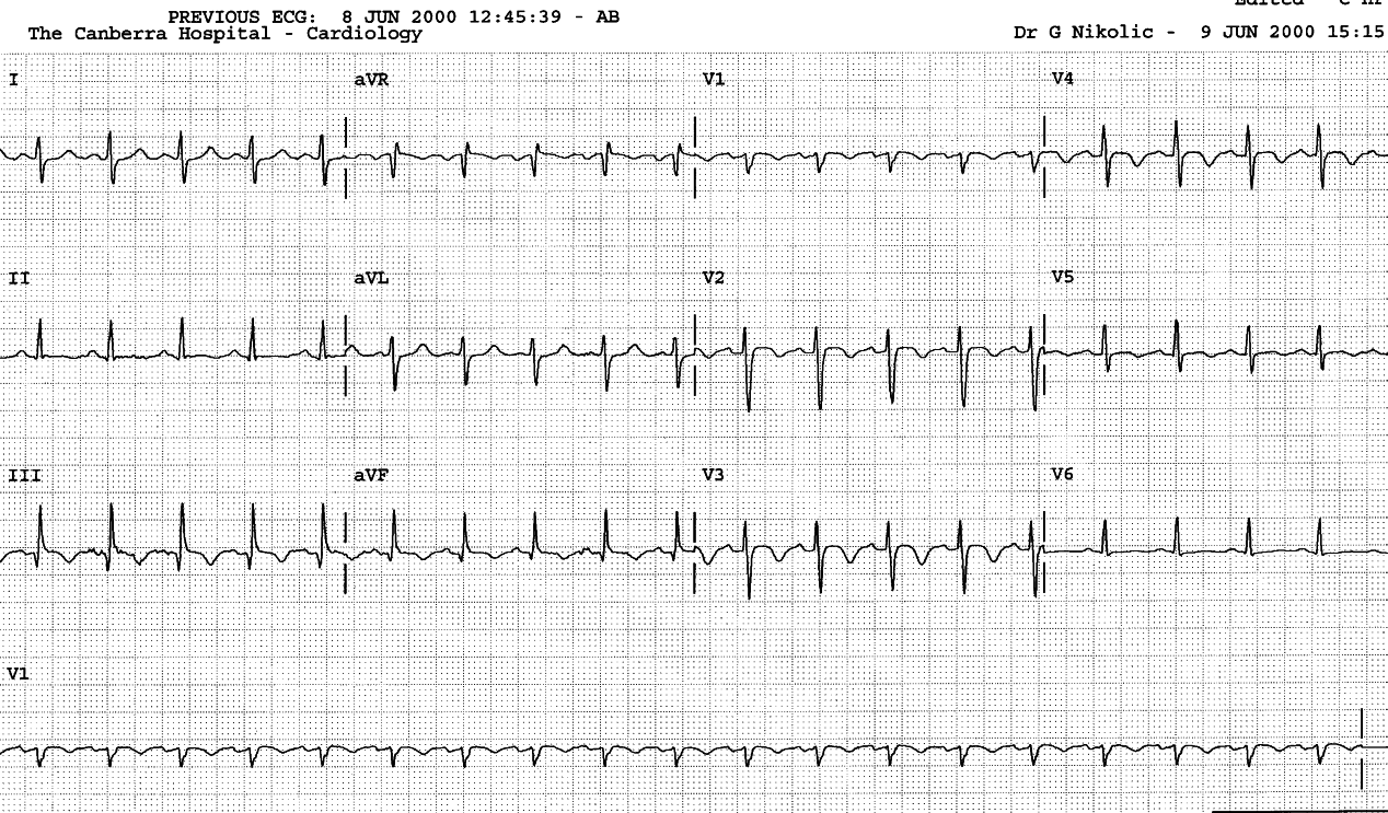 Right precordial T inversion develops some time after the event and implies a large embolus.