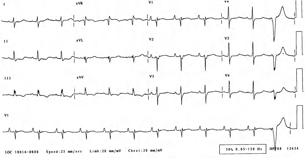 59 year old lady with recurrent palpitations and normal coronary arteries. What is the cause of her predicament? 