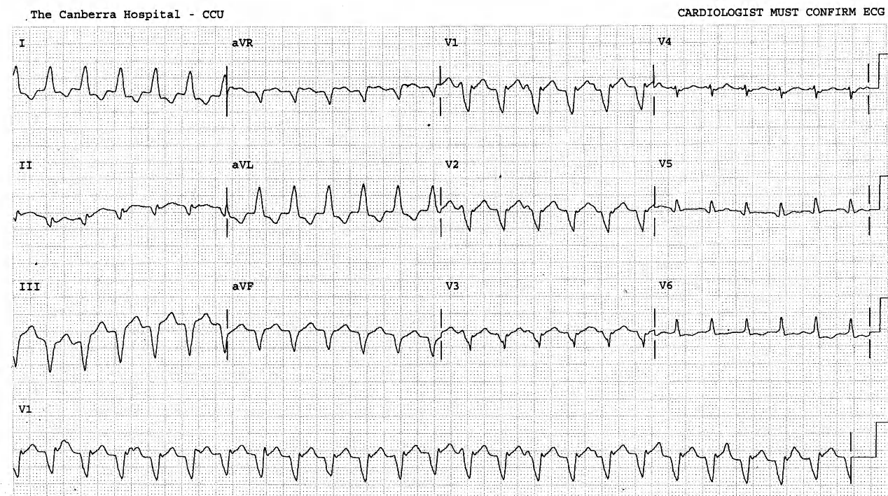 ARVD VT. There is also some easily seen dissociated atrial activity. 