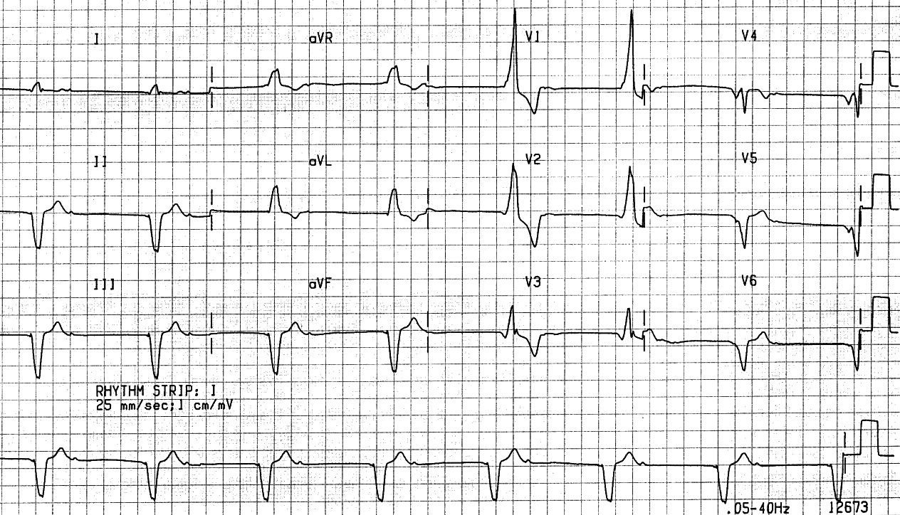 58 year old man with COCM prior to insertion of a temporary pacemaker. His digoxin level was barely therapeutic at 0.5 ng/cc [0.4 -1.4]. 